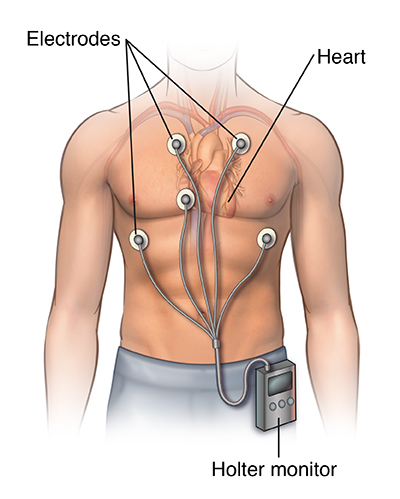 Holter cardiaco